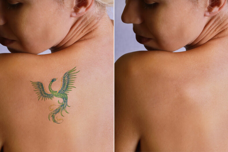 Six Tattoo Removal Sessions – Small, Medium, Large Areas £59.00 instead of £180.00
