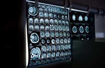 Transforming Healthcare: The Impact of AI on Diagnosis, Treatment, and Patient Care