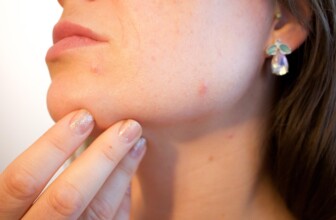 Clear Skin Ahead: The Ultimate Guide to Effective Acne Treatments