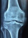 Building Stronger Bones: Essential Strategies for Osteoporosis Prevention
