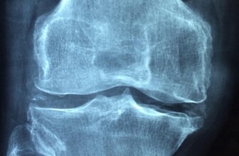 Building Stronger Bones: Essential Strategies for Osteoporosis Prevention