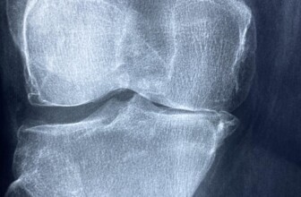 Discovering Relief: Innovative Strategies for Managing Arthritis Pain