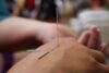 Top 10 Acupuncture Clinics Revolutionizing Wellness
