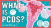 What Is PCOS? How Can Exercise and Nutrition Help | Nutritionist Explains… | Myprotein