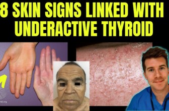Doctor explains 8 SKIN SIGNS linked with HYPOTHYROIDISM (aka underactive thyroid)