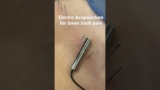 Electro Acupuncture for lower back pain