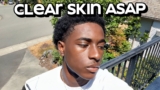 how to get clear skin for guys asap