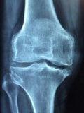 Building Stronger Bones: Essential Strategies for Osteoporosis Prevention